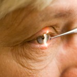 Early Stage Macular Degeneration Laser Treatment