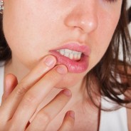 Naturally Preventing and Healing Herpes