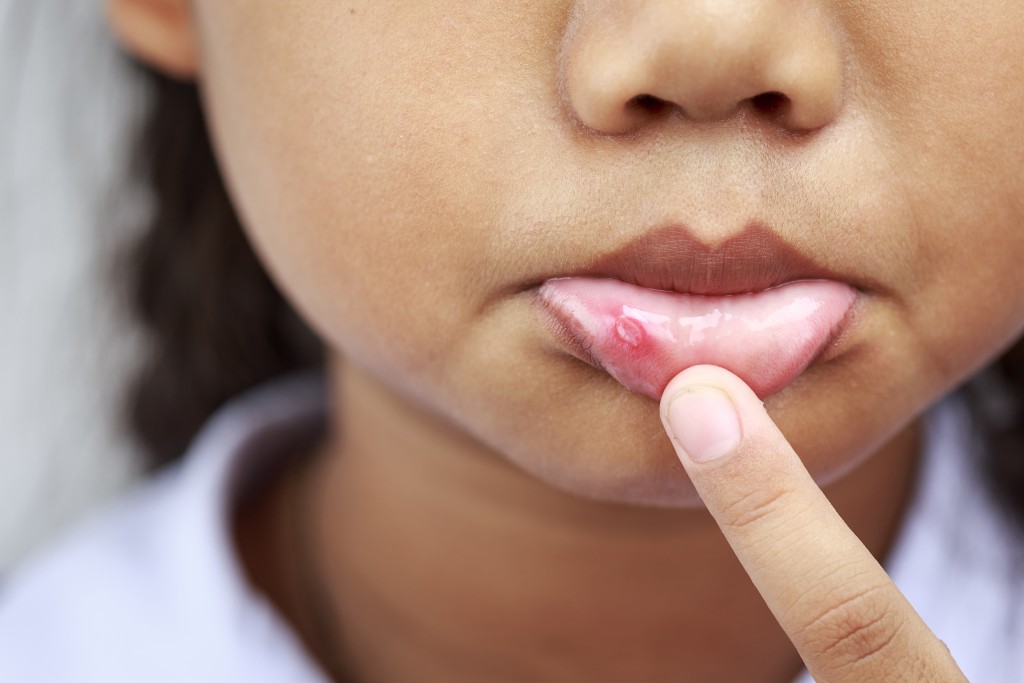 7 Alternative Remedies for Canker Sores