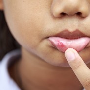 7 Alternative Remedies for Canker Sores