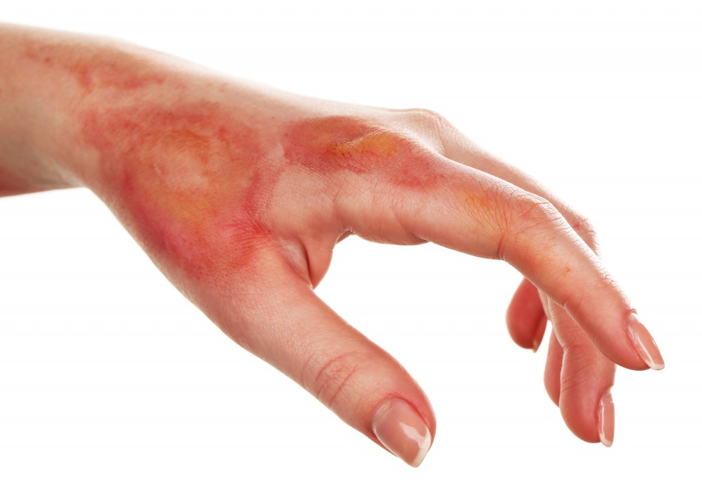 5 Natural Minor Burn Remedies