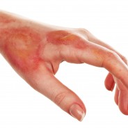 5 Homemade Ways to Naturally Treat a Minor Burn