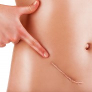 6 Natural Ways to Heal Scar Tissue