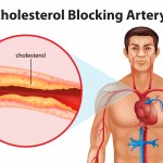 Alternative Remedies for High Cholesterol