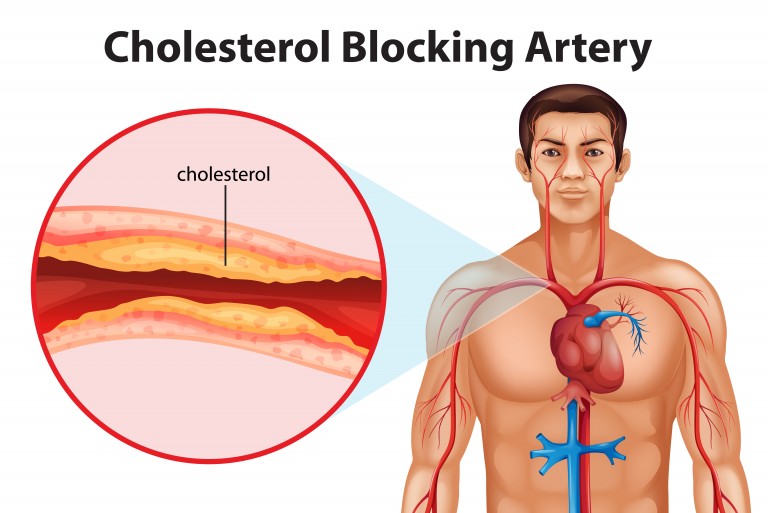 Alternative Remedies for High Cholesterol