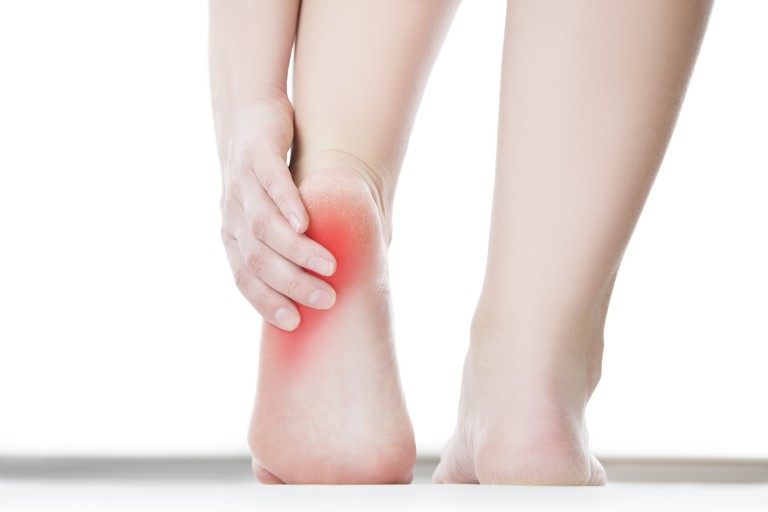 5 Steps to Treating Plantar Fasciitis