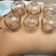 Cupping: It Helped Phelps, Can It Help You?