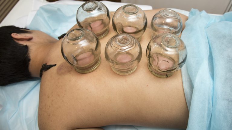 Cupping: It Helped Phelps, Can It Help You?