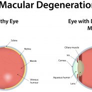 Surprising Risks Reported Linked to Macular Degeneration