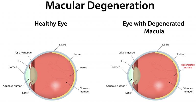 Surprising Risks Reported Linked to Macular Degeneration