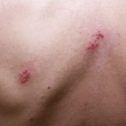 12 Natural Treatments for Shingles