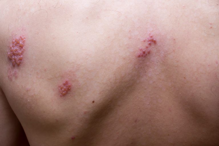 12 Natural Treatments for Shingles