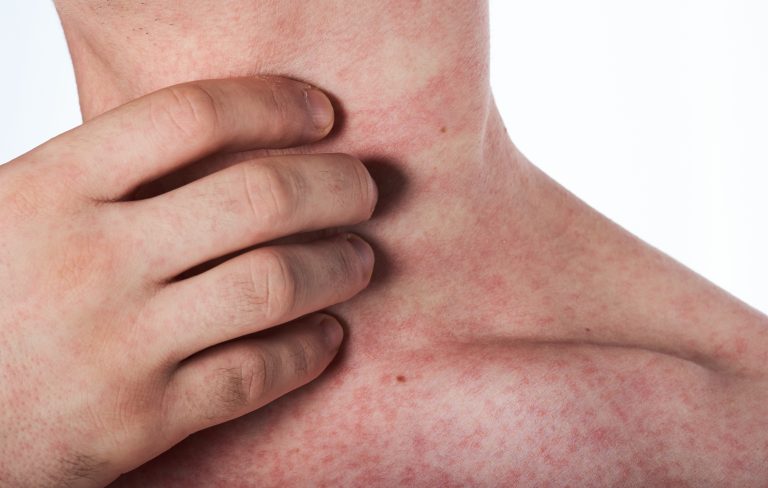 6 Natural Ways to Treat a Rash