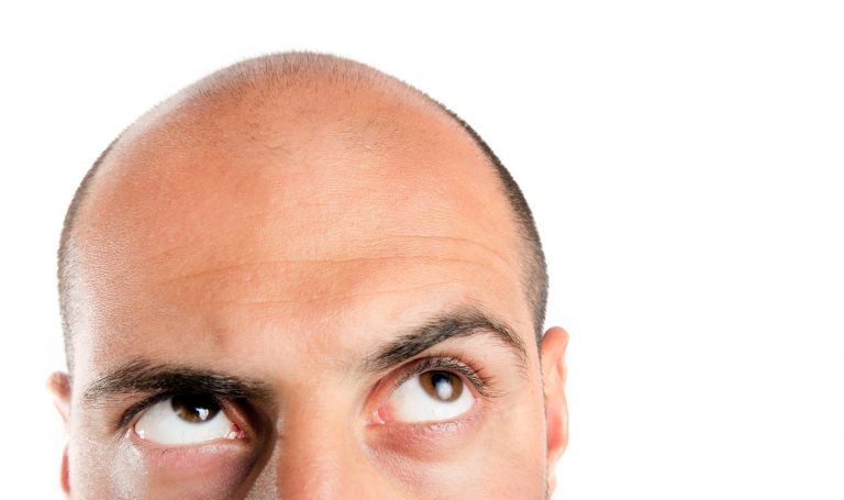 5 Natural Topical Remedies to Combat Baldness