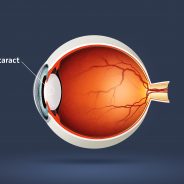The Future of Non-Surgical Cataract Treatment