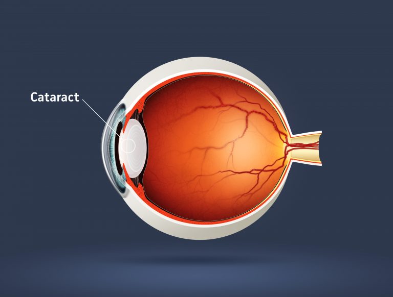 The Future of Non-Surgical Cataract Treatment