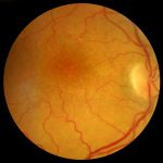 Macular Degeneration: Retina Patch, Tracker and Protein