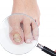 3 Natural Remedies for Toenail Fungus