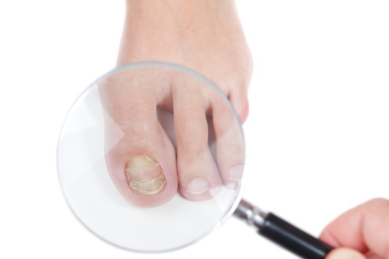 3 Natural Remedies for Toenail Fungus