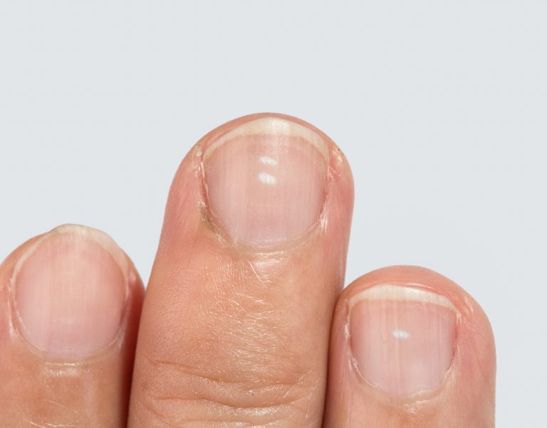 Your Fingernails May Be Telling You Something