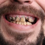5 Habits That Ruin Your Teeth