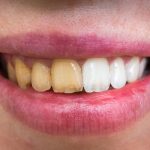 Surprising Natural Remedies For Yellowing Teeth