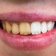 Surprising Natural Remedies For Yellowing Teeth