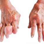 Diabetes, Insomnia and Gout Linked to AMD