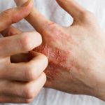 Skin Formula: 3 Natural Remedies for Eczema