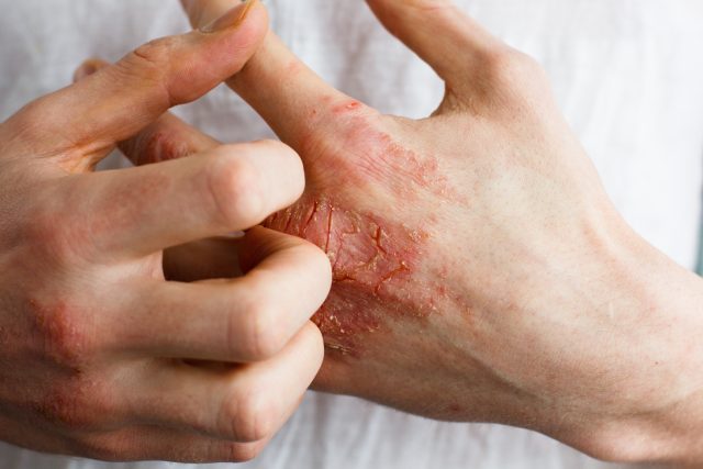 Skin Formula: 3 Natural Remedies for Eczema