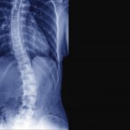 Tips to Help You Perform a Home Screening for Scoliosis