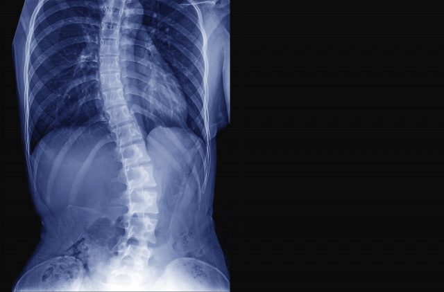 Tips to Help You Perform a Home Screening for Scoliosis