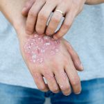 5 Natural Remedies for Psoriasis and Eczema