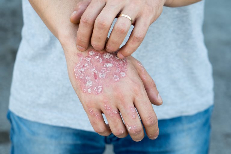 5 Natural Remedies for Psoriasis and Eczema