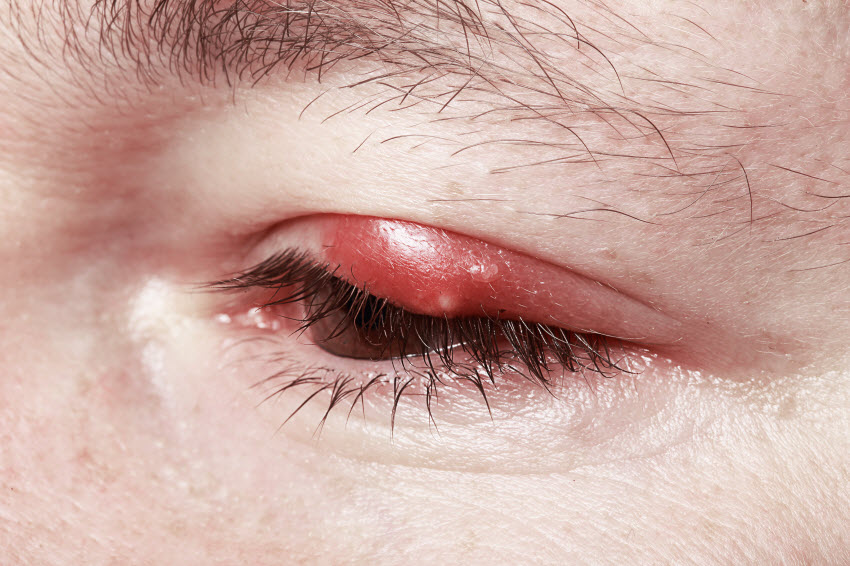 3 Natural Remedies for Stye Relief