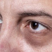 Stop Dark Circles Naturally