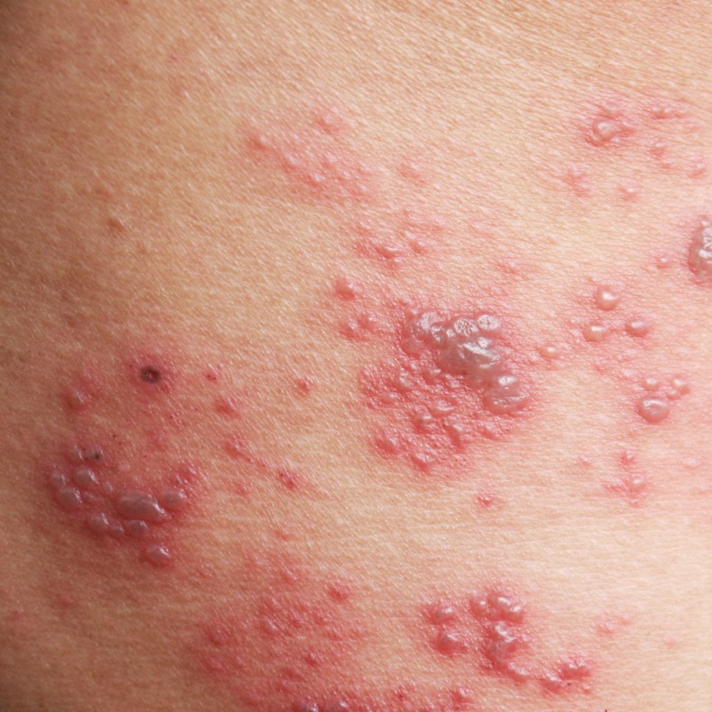 Raised red bumps and blisters caused by shingles on skin | Daily Health ...