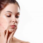 5 Vitamin Remedies for Acne