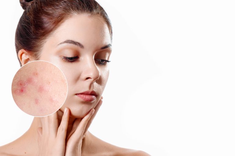 5 Vitamin Remedies for Acne