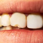 7 Major Mistakes That Damage Our Teeth
