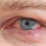 Acupuncture Treats Dry Eye Syndrome