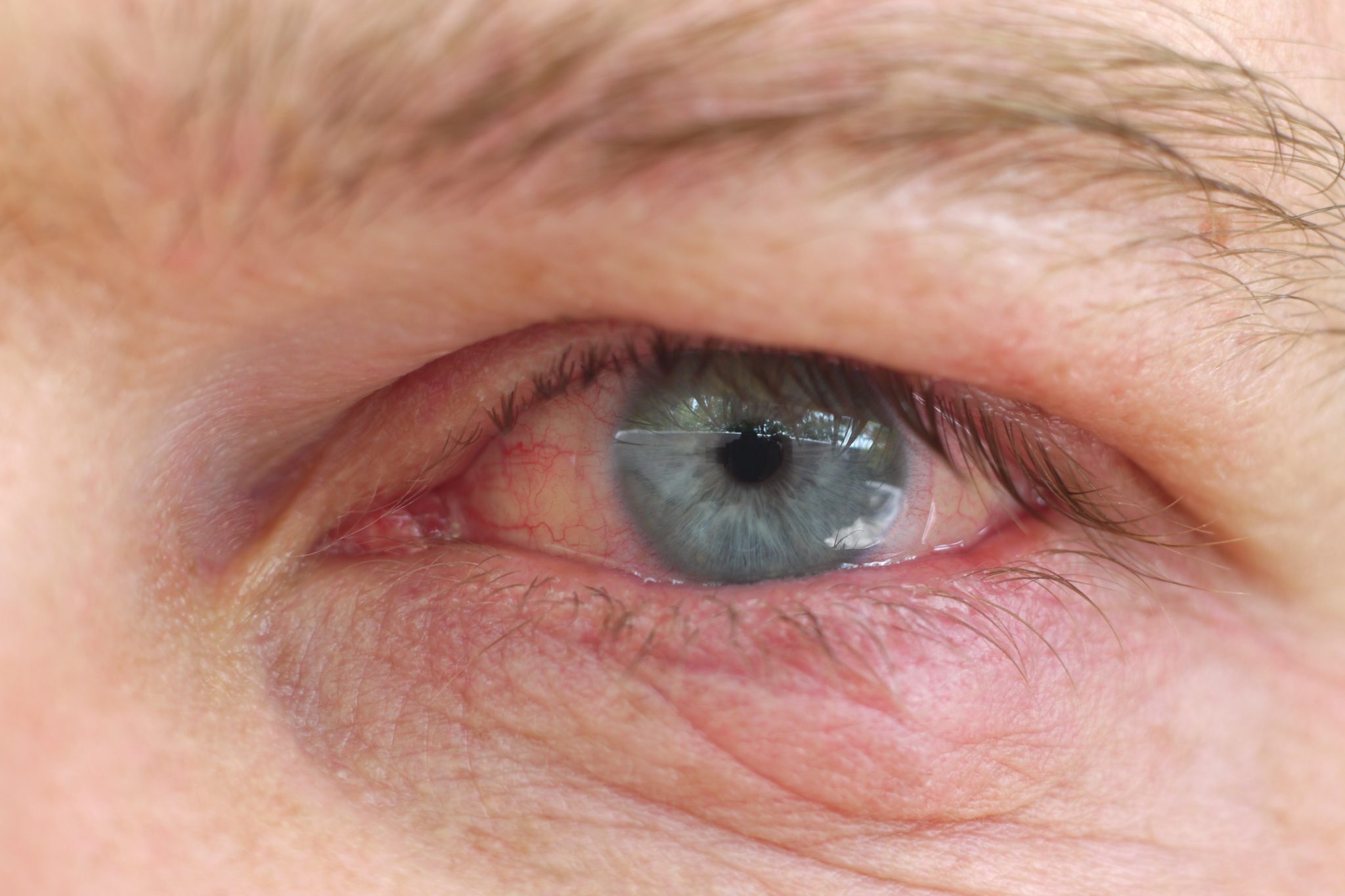 eye-infection-infection-of-an-eyelid-on-an-eye-with-contact-lens