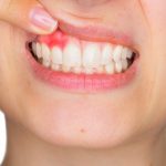 Macular Degeneration Linked to Gum Disease