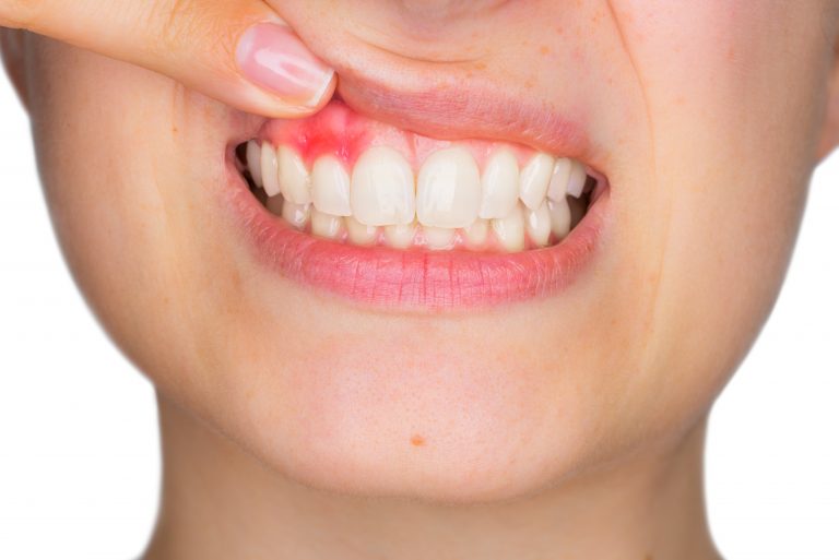 Macular Degeneration Linked to Gum Disease