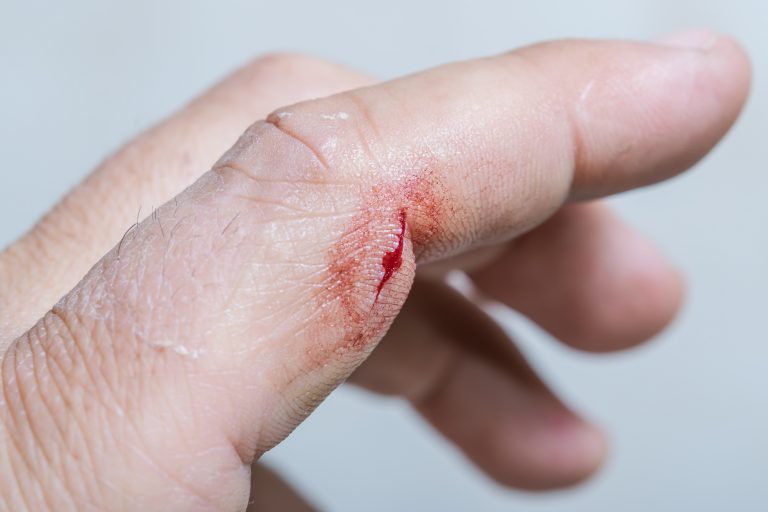 4 Natural Home Wound Healing Hacks