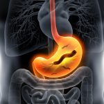 Natural Help for H. Pylori
