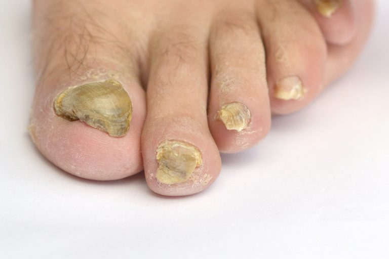 Home Remedy Toenail Fungus Fixes