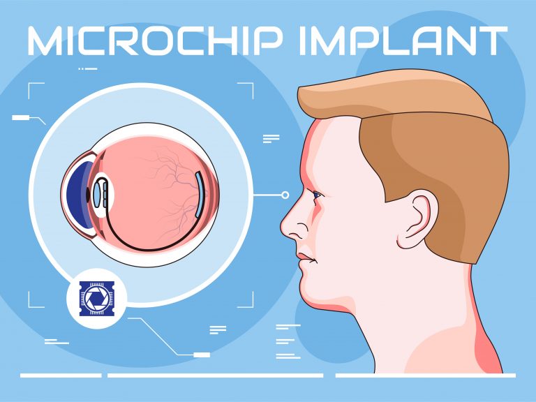 Micro-Implant and Calcium for End-Stage Macular Degeneration