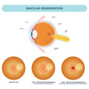 Detecting Drusen Before Macular Degeneration May Help Prevent Disease 