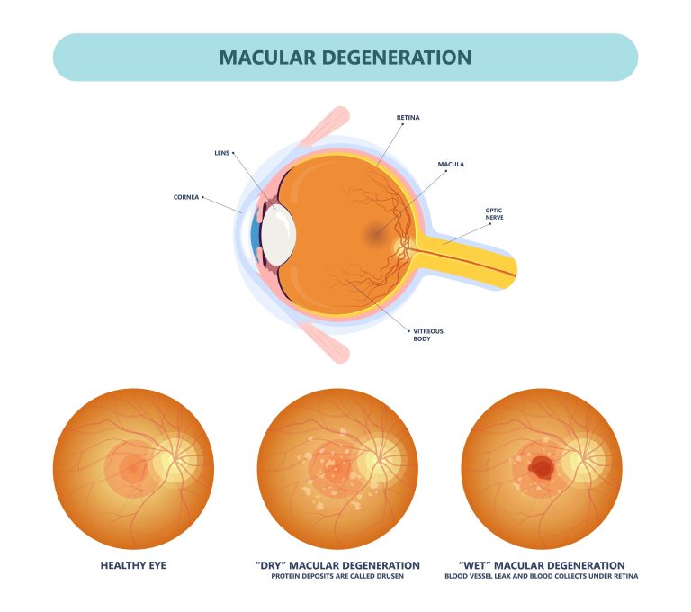 Detecting Drusen Before Macular Degeneration May Help Prevent Disease 